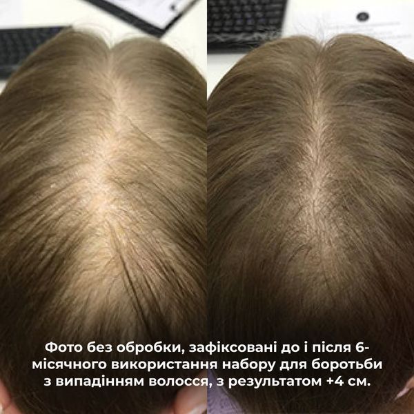 Кондиціонер проти випадіння волосся Hillary Serenoa & РР Hair Loss Control Сonditioner, 500 мл HI-07-769 фото