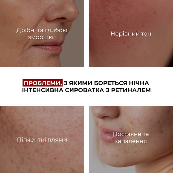 Комплекс нічного догляду для себорегуляції та корекції висипань Hillary Night Care Complex for Oil Control & Acne Correction K-11-729 фото