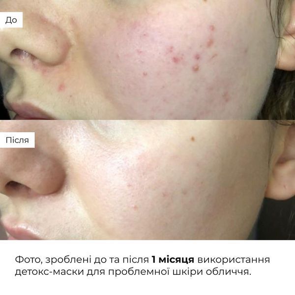 Комплекс нічного догляду для себорегуляції та корекції висипань Hillary Night Care Complex for Oil Control & Acne Correction K-11-729 фото