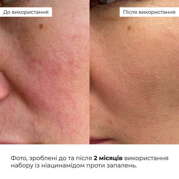 Набір із ніацинамідом проти запалень Hillary Niacinamide Anti-Inflammation Set K-11-341 фото