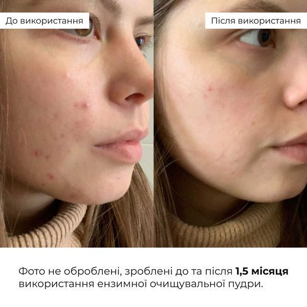 Набір інтенсивного догляду проти висипань та жирного блиску Hillary Intensive Anti-Blemish & Oil Control Set K-11-451 фото