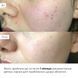 Набір інтенсивного догляду проти висипань та жирного блиску Hillary Intensive Anti-Blemish & Oil Control Set K-11-451 фото 7