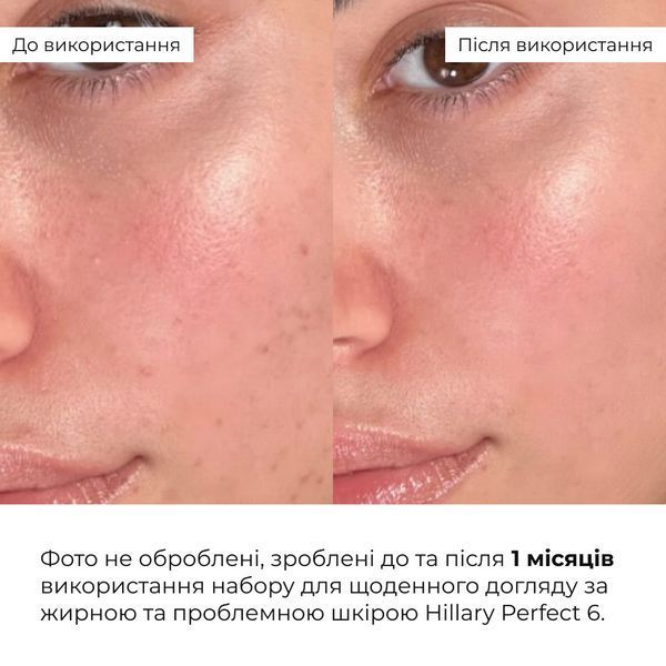 Набір для щоденного догляду за жирною та проблемною шкірою Hillary Perfect 6 M-11-019 фото