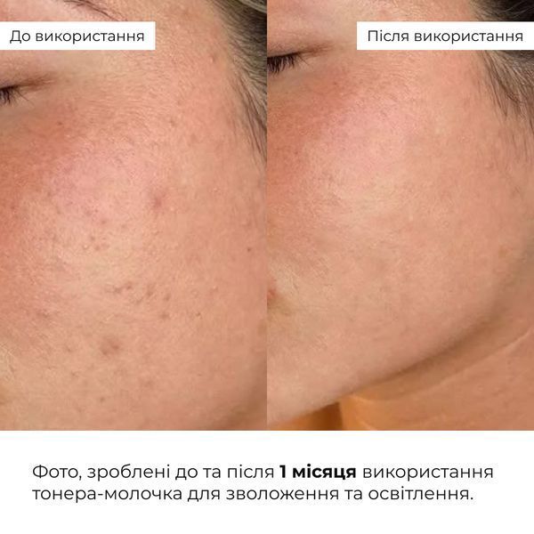 Набір для зменшення набряків та глибокого зволоження шкіри обличчя Hillary Puffiness & Deep Hydration Facial Set K-11-396 фото
