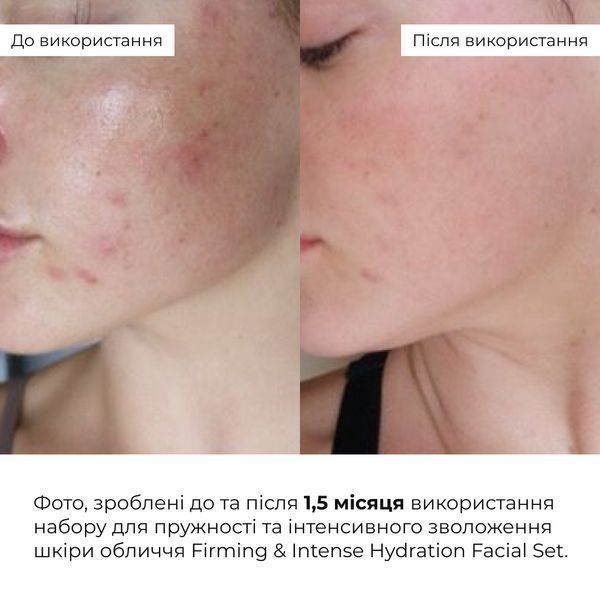 Набір для зменшення набряків та глибокого зволоження шкіри обличчя Hillary Puffiness & Deep Hydration Facial Set K-11-396 фото