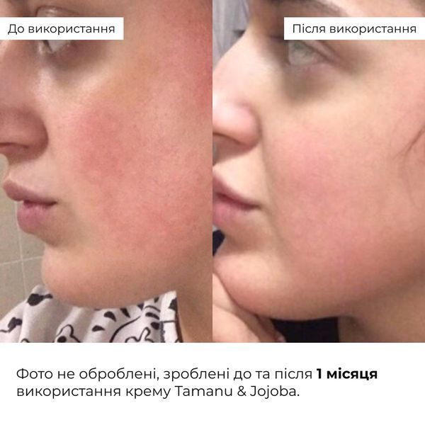 Набір себорегулюючого догляду для жирної та проблемної шкіри обличчя Hillary for oily and problematic skin K2-11-309 фото