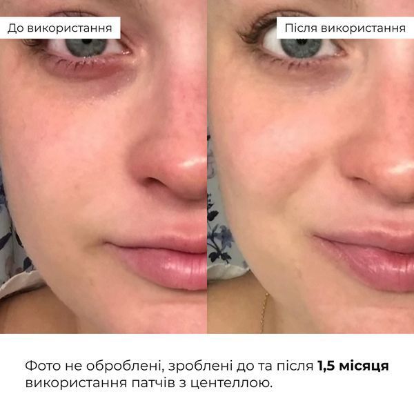 Мультифункціональні та заспокійливі патчі Hillary Niacinamide & Centella K2-11-458 фото