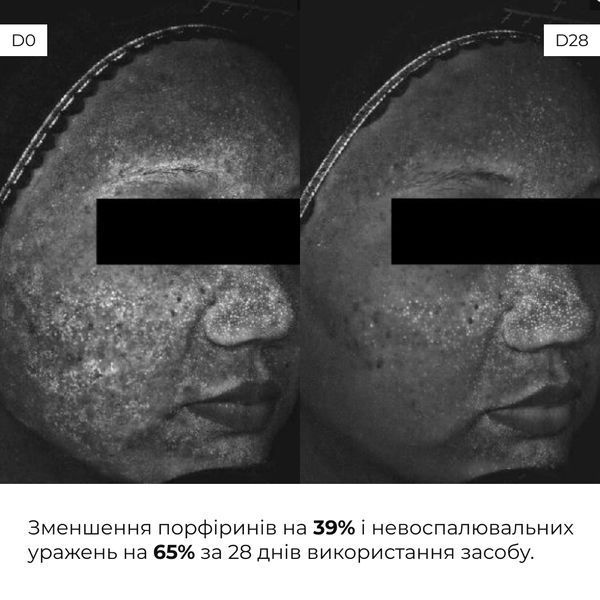 Набір себорегулюючого догляду для жирної та проблемної шкіри обличчя Hillary for oily and problematic skin K2-11-309 фото
