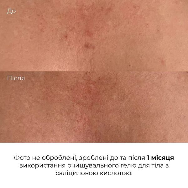 Очищувальний гель для тіла з саліциловою кислотою Hillary Anti-Acne Salicylic Body Wash, 200 мл HI-01-427 фото