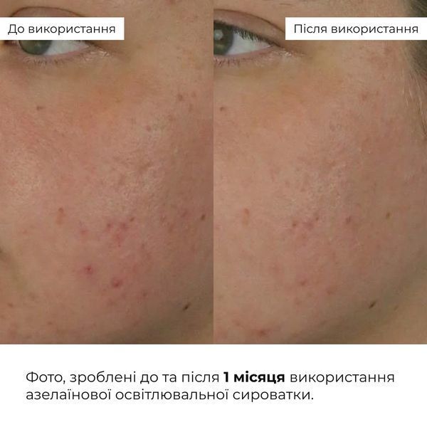 Набір відновлення після запалень та постакне Hillary Recovery Set for Post-Inflammation & Post-Acne K-11-650 фото