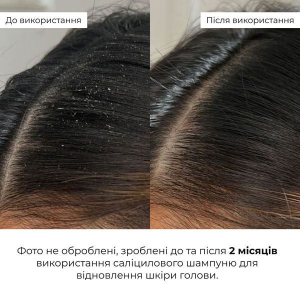Комплекс для глибокого очищення та відновлення волосся і шкіри голови з термозахистом Hillary Deep Cleanse & Hair Restoration Set with Heat Protection K-11-498 фото