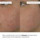 Набір відновлення після запалень та постакне Hillary Recovery Set for Post-Inflammation & Post-Acne K-11-650 фото 5