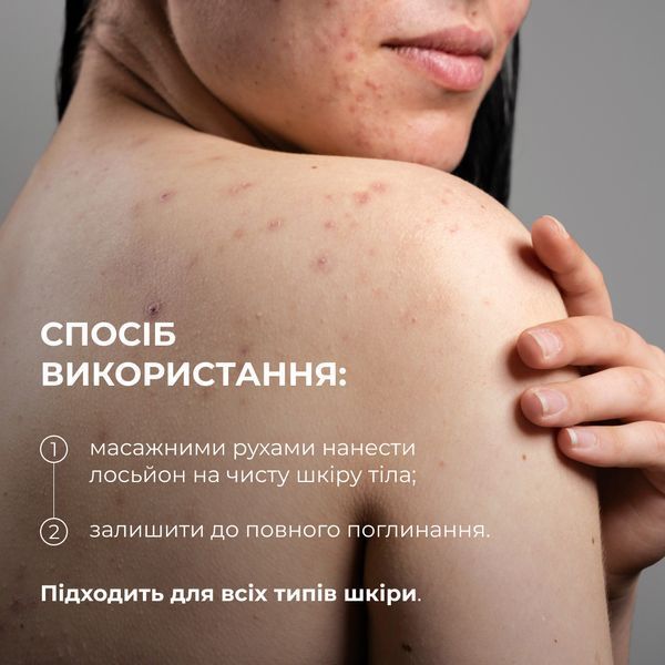 Лосьйон-детокс для проблемної шкіри з саліциловою кислотою Hillary Anti-Acne Salicylic Body Lotion, 150 мл HI-08-957 фото