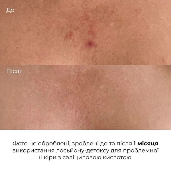 Лосьйон-детокс для проблемної шкіри з саліциловою кислотою Hillary Anti-Acne Salicylic Body Lotion, 150 мл HI-08-957 фото