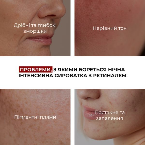 Набір для захисту шкіри та боротьби з акне вночі Hillary Acne Defense & Barrier Care Kit K-11-243 фото