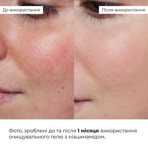 Набір для зменшення жирності, висипань і тьмяного тону шкіри Hillary Anti-Oil & Glow Boost Set K-11-427 фото