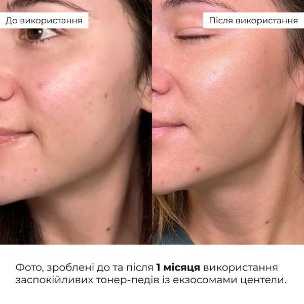 Комплекс для контролю жирного блиску та звуження пор Hillary Oil Control & Pore Refining Set K-11-444 фото