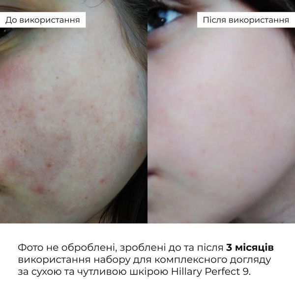 Набір для комплексного догляду за сухою та чутливою шкірою Hillary Perfect 9 HI-11-968 фото