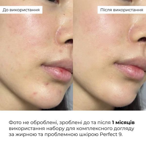 Набір для комплексного догляду за жирною та проблемною шкірою Hillary Perfect 9 HI-11-314 фото