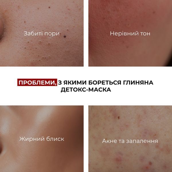 Набір для очищення та боротьби з акне Hillary Anti-Acne & Detox Skin Set K-11-634 фото