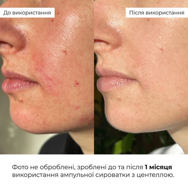 Набір для миттєвого відновлення та зменшення набряків Hillary Instant Freshness & Puffiness Relief Kit K-11-717 фото